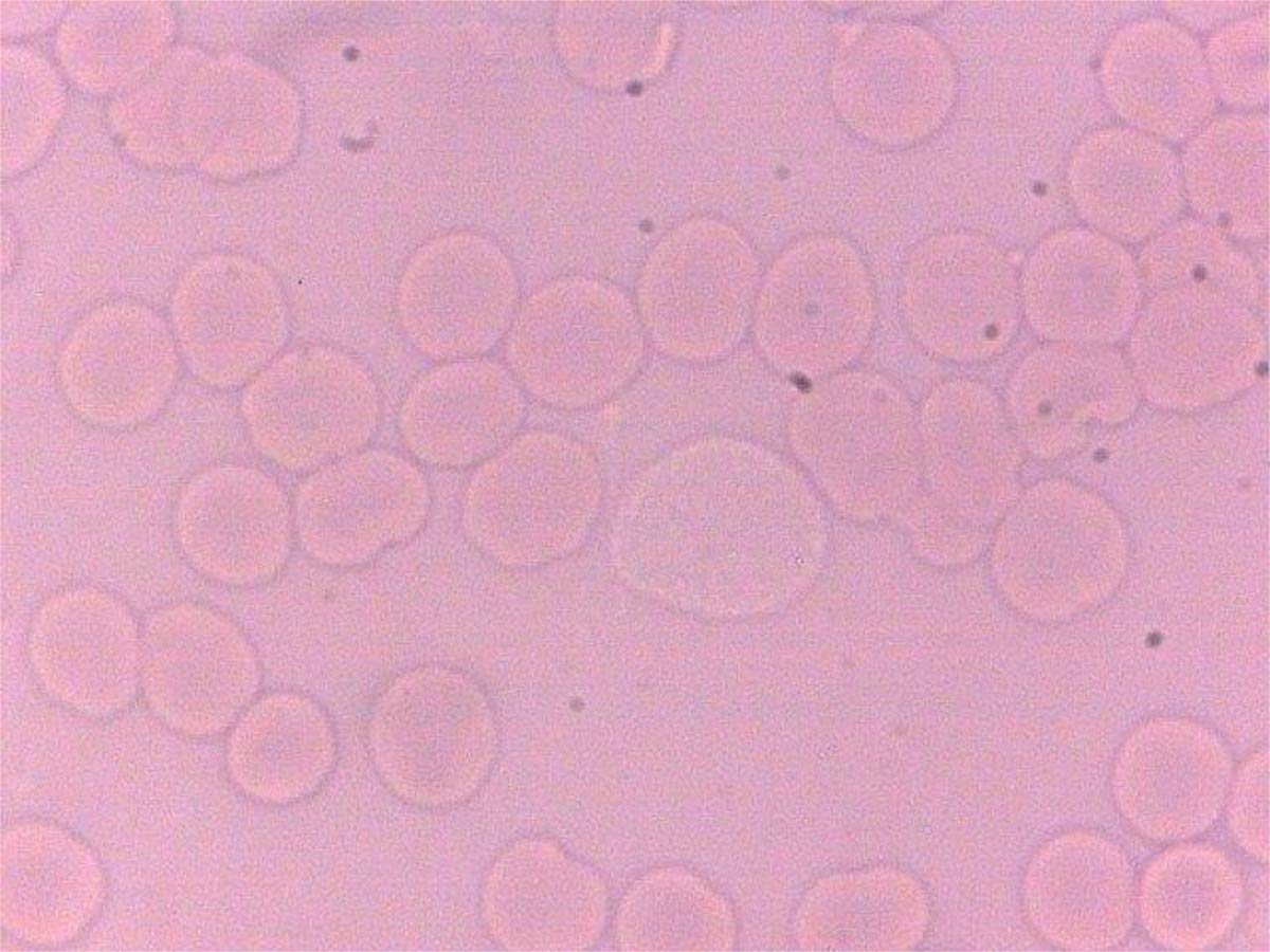 After E+V for treatment of advanced prostate cancer